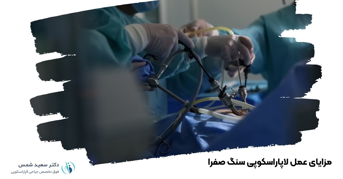 مزایای عمل لاپاراسکوپی سنگ صفرا 
