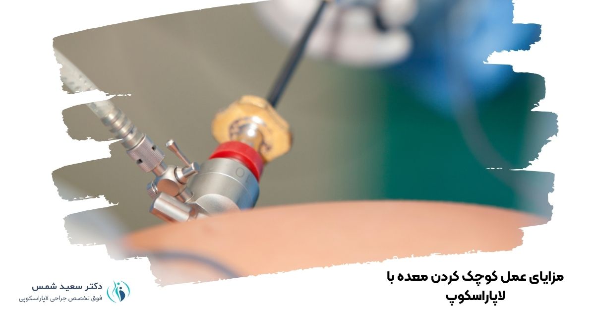 مزایای عمل کوچک کردن معده با لاپاراسکوپ