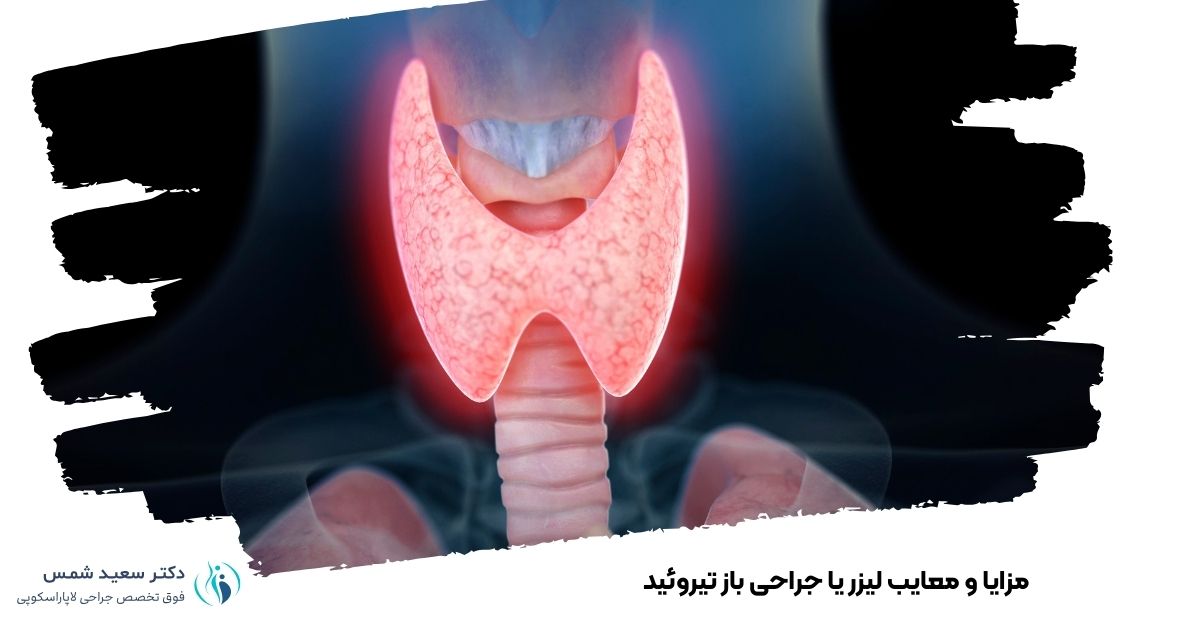 مزایا و معایب لیزر یا جراحی باز تیروئید
