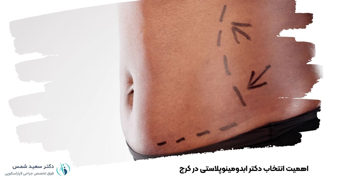 اهمیت انتخاب دکتر ابدومینوپلاستی در کرج 
