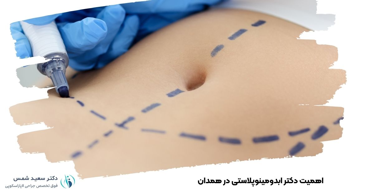 اهمیت دکتر ابدومینوپلاستی در همدان 