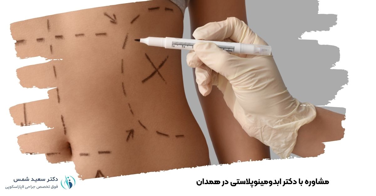 مشاوره آنلاین دکتر ابدومینوپلاستی در همدان 