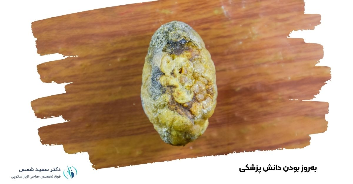 بهروز بودن دانش پزشکی دکتر سنگ صفرا در قزوین