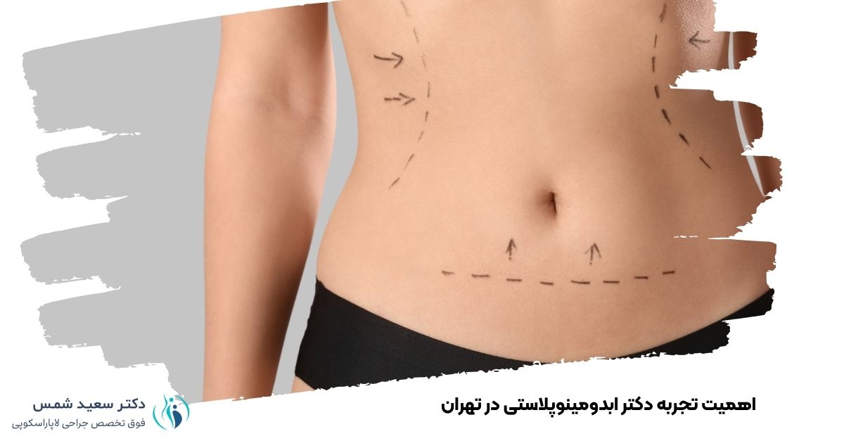 اهمیت تجربه دکتر ابدومینوپلاستی در تهران