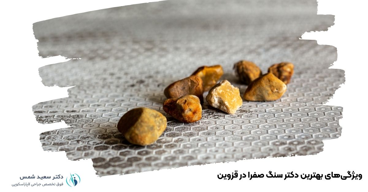 ویژگیهای بهترین دکتر سنگ صفرا در قزوین
