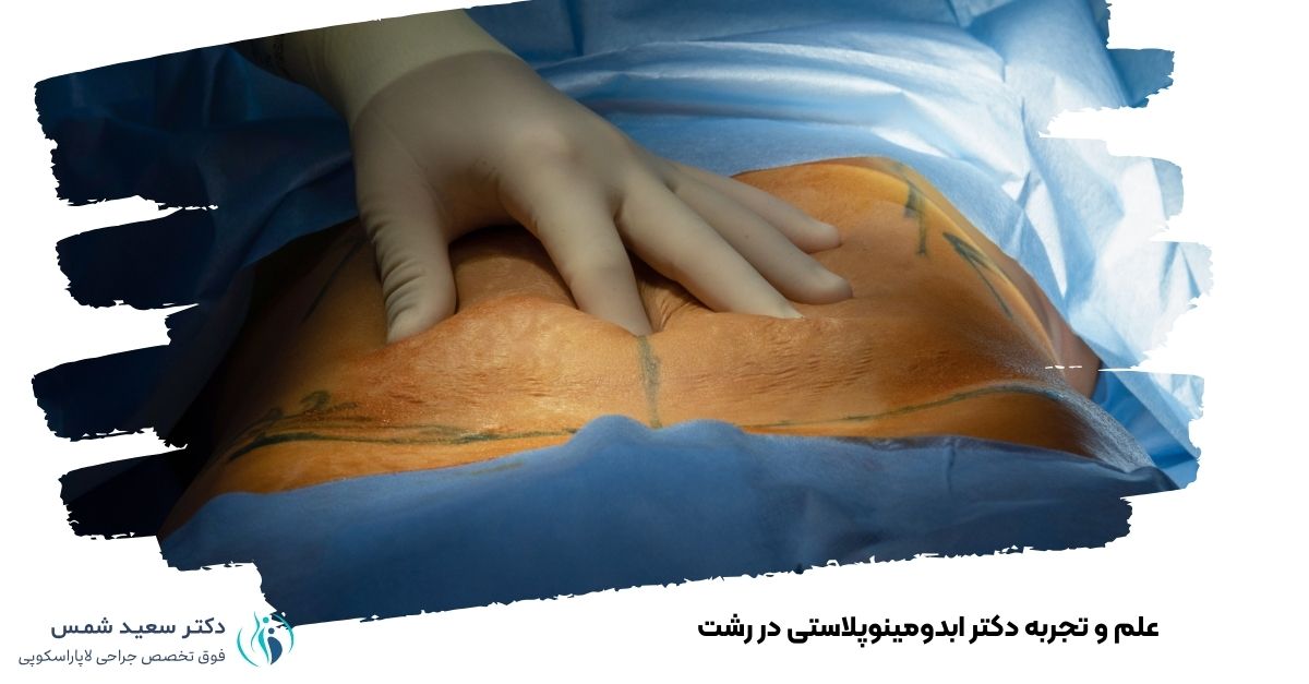 علم و تجربه دکتر ابدومینوپلاستی در رشت