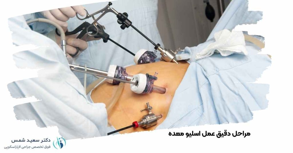 مراحل دقیق عمل اسلیو معده