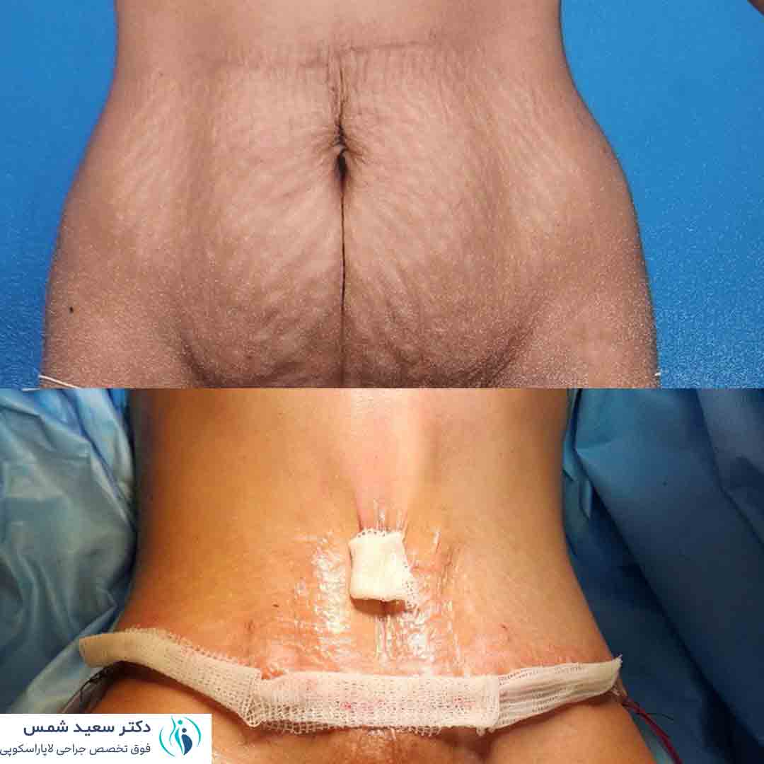 رضایت بیماران پس از عمل ابدومینوپلاستی