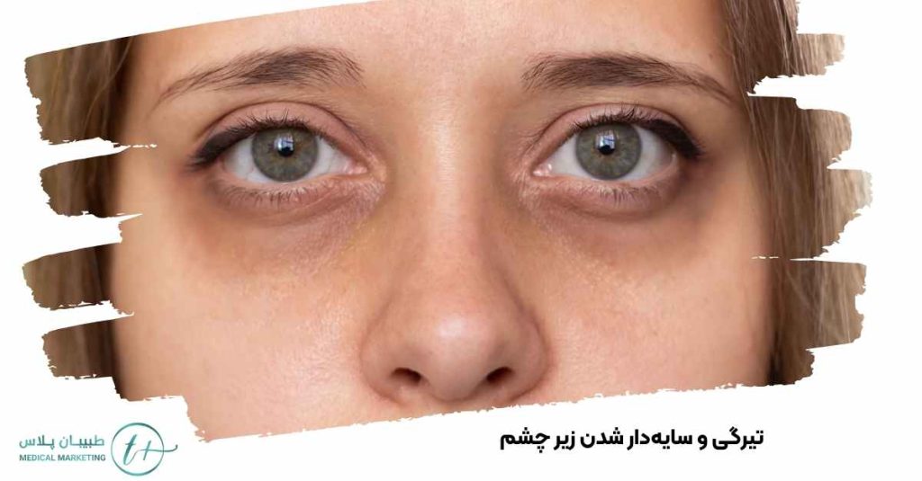 تیرگی و سایهدار شدن زیر چشم