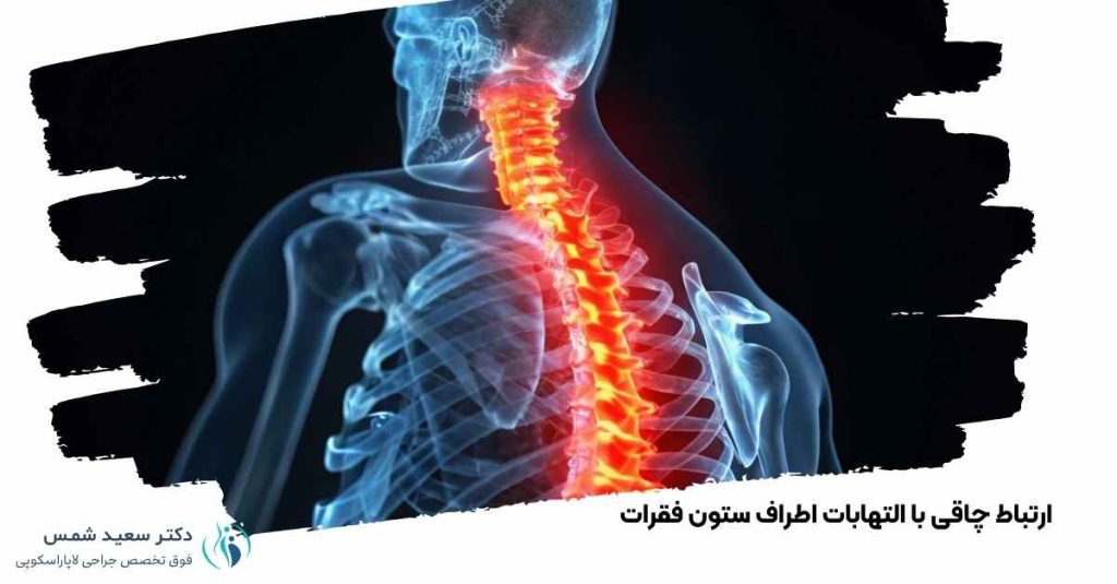 ارتباط چاقی با التهابات اطراف ستون فقرات