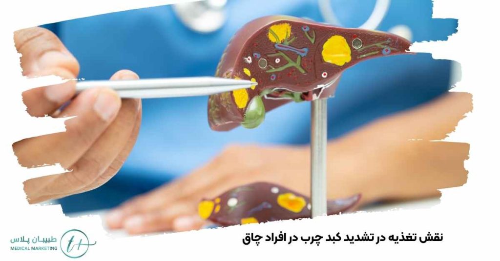 نقش تغذیه در تشدید کبد چرب افراد چاق