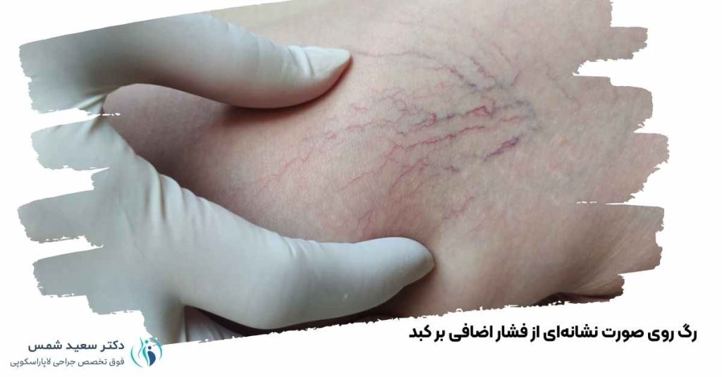 رگ روی صورت نشانهای از فشار اضافی بر کبد