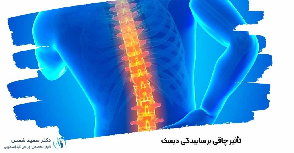 تأثیر چاقی بر ساییدگی دیسک