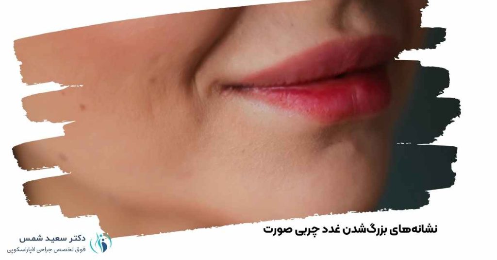 نشانههای بزرگشدن غدد چربی صورت