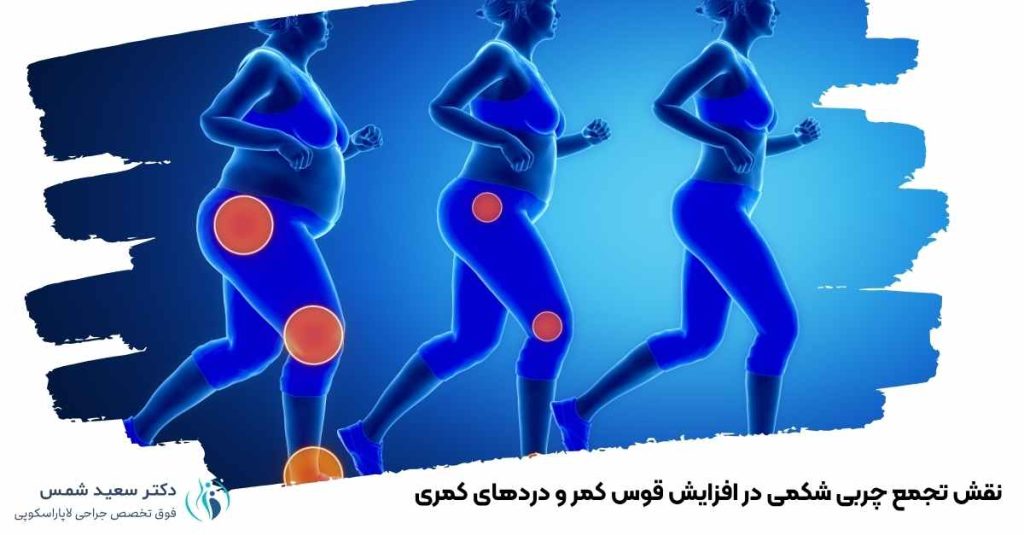 نقش تجمع چربی شکمی در دردهای کمری