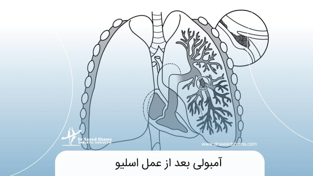 آمبولی بعد از عمل اسلیو