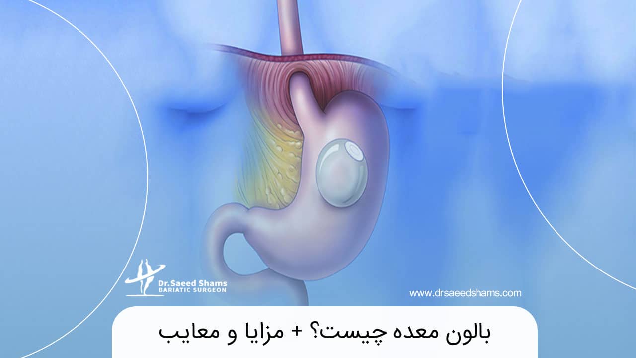 بالون معده