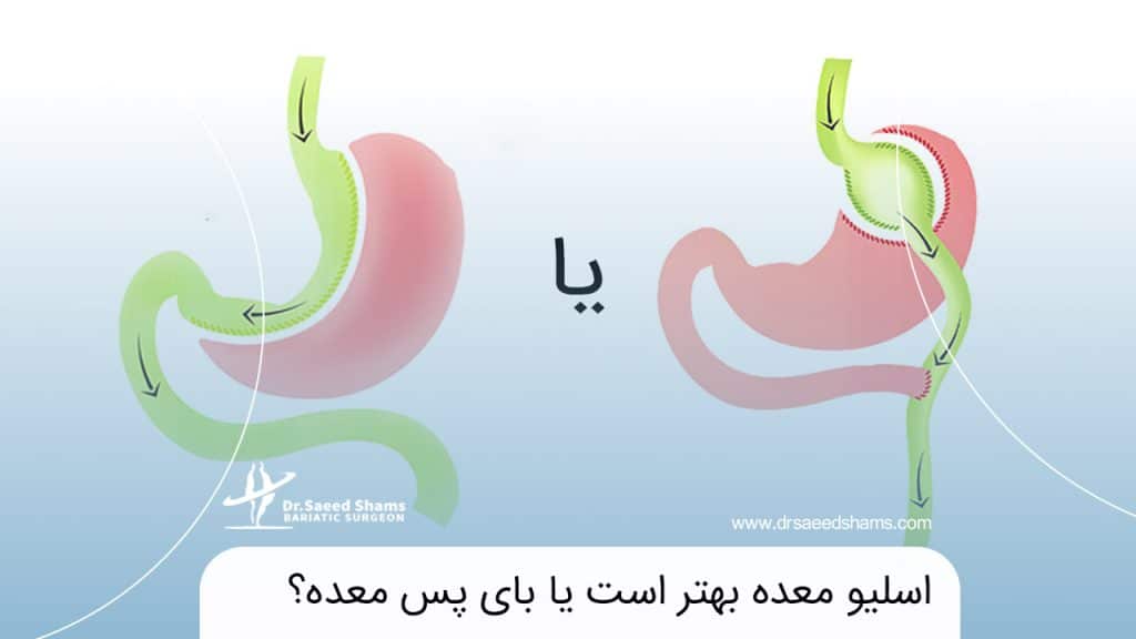 اسلیو معده بهتر است یا بای پس معده