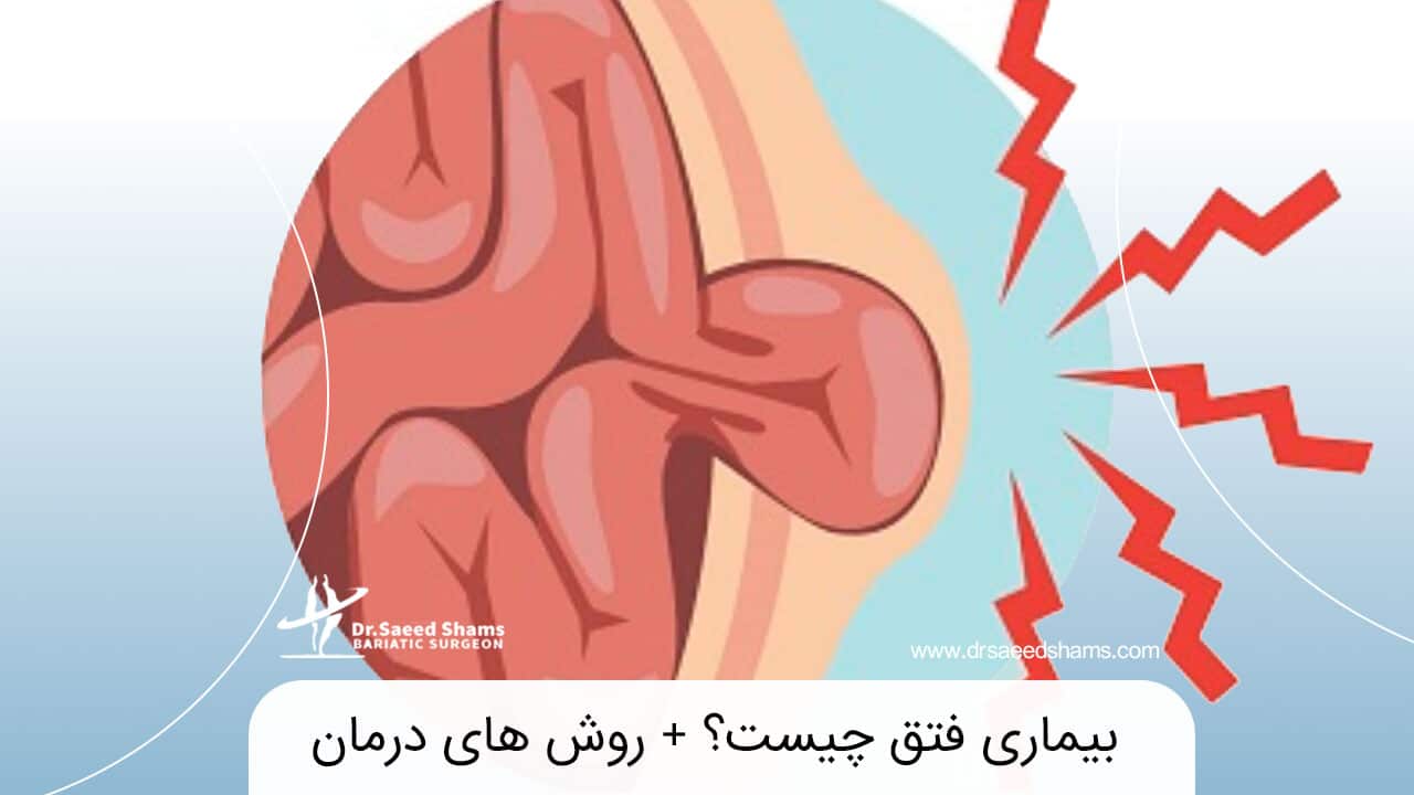 باد فتق