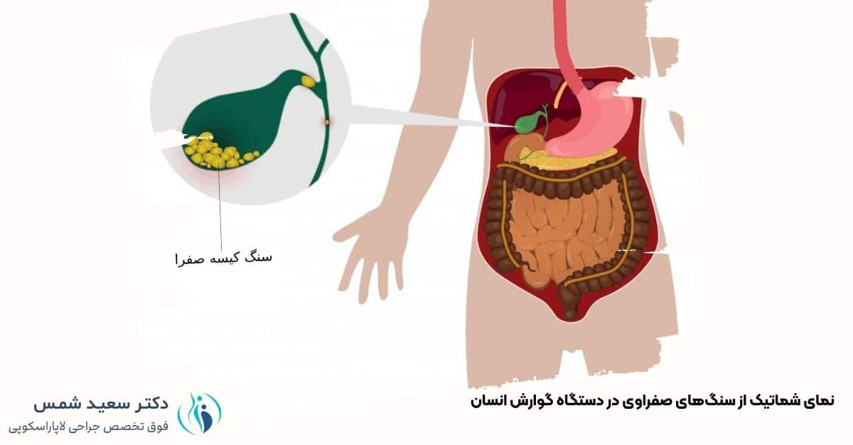 نمای شماتیک از سنگ‌های صفراوی در دستگاه گوارش انسان - دکتر شمس