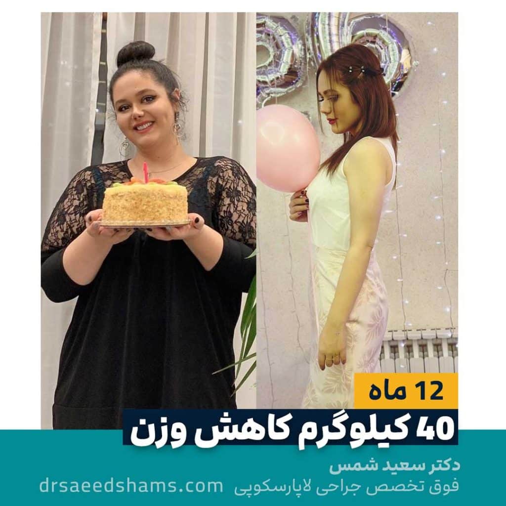 کاهش چهل کیلویی وزن پس از اسلیو معده 