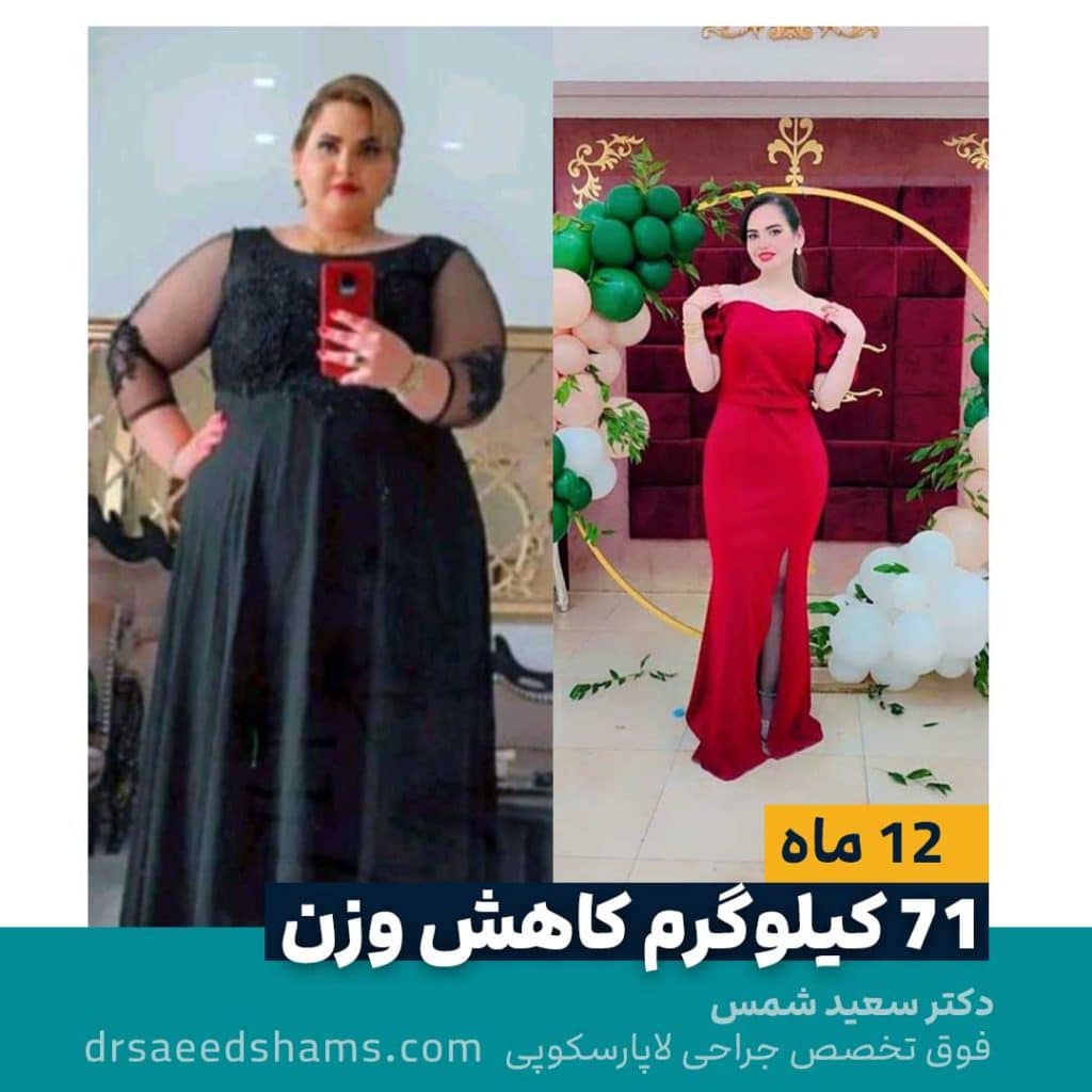 کاهش وزن اسلیو معده ۷۱ کیلیویی 