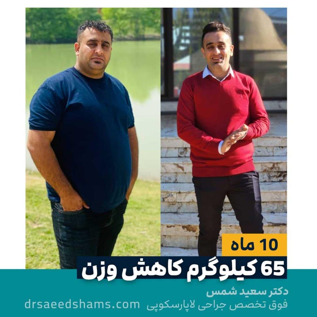 کاهش وزن ۶۵ کیلیو پس از اسلیو معده 