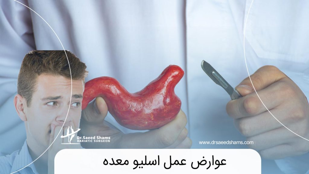 عوارض عمل اسلیو معده