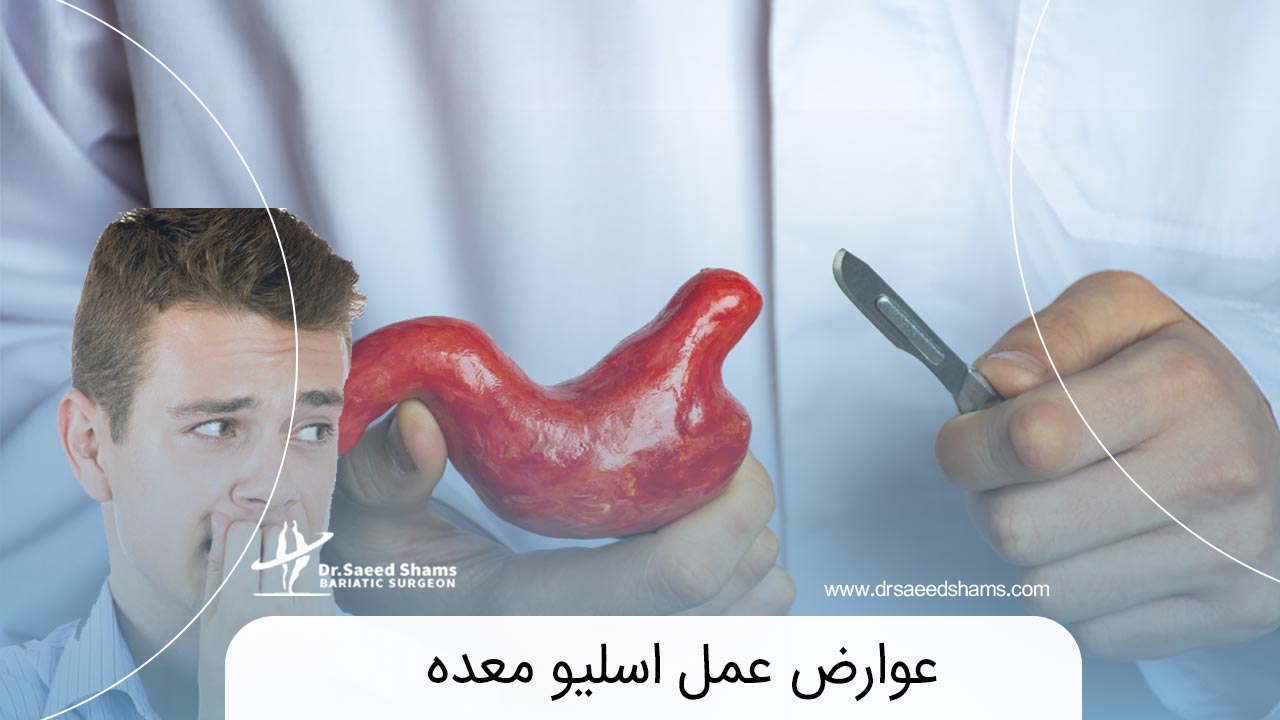 عوارض عمل اسلیو معده