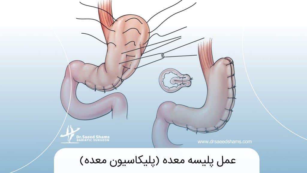 عمل پلیسه معده