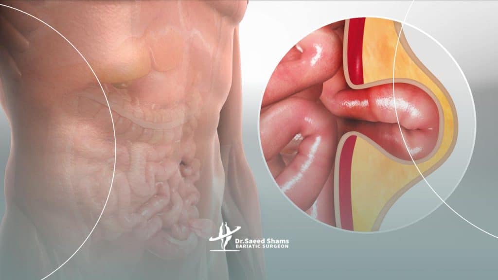 فتق چیست؟
