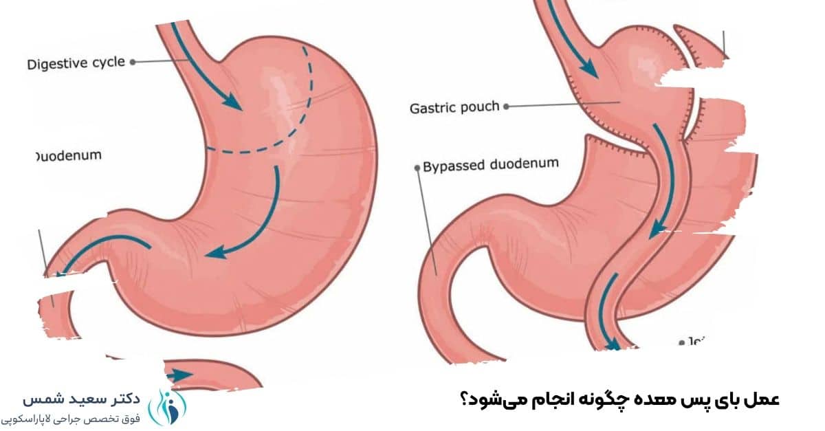 عمل بای پس معده چگونه انجام می‌شود؟