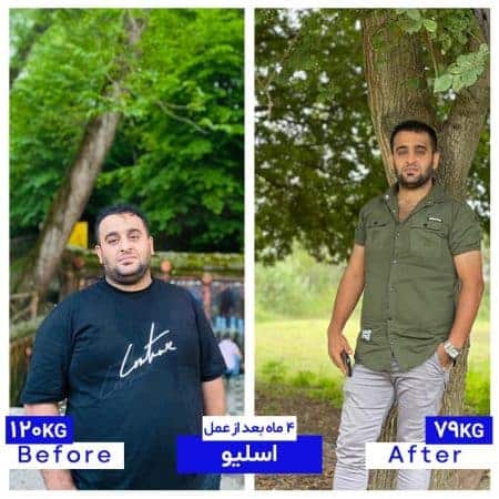۶۰کیلو کاهش وزن پس از اسلیو معده
