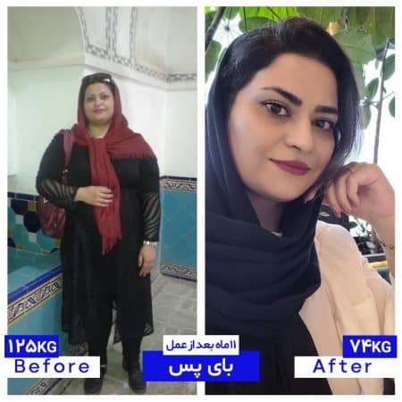 ۷۰ کیلیو کاهش وزن پس از بای پس معده