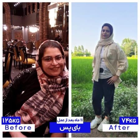 جراحی بای پس معده توسط دکتر سعید شمس