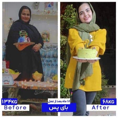 ۶۰ کیلیو کاهش وزن پس از بای پس معده