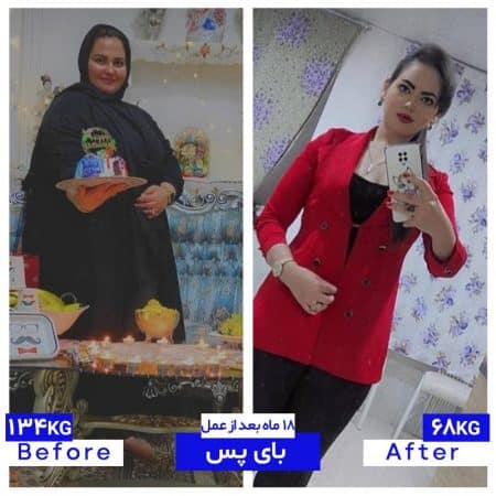 ۶۰ کیلو کاهش وزن پس از جراحی لاغری اسلیو معده توسط دکتر سعید شمس