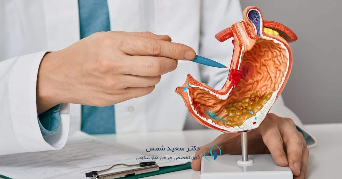اسلیو معده چیست در این تصویر اسلیو معده را مشاهده میکنید
