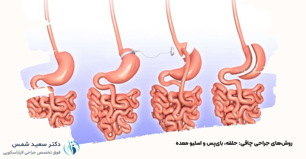 شماتیک روش‌های جراحی چاقی: حلقه‌گذاری، بای‌پس و اسلیو معده. دکتر شمس