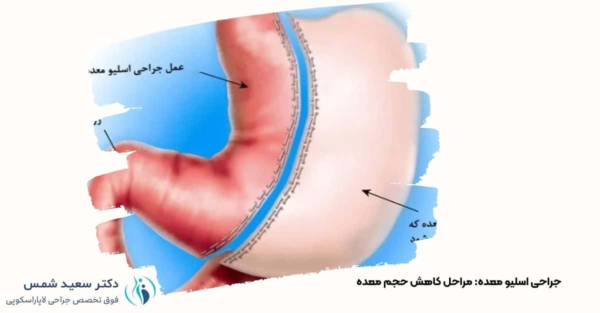 شماتیک جراحی اسلیو معده: نمایش بخش برداشته‌شده معده و اتصال به روده. دکتر شمس