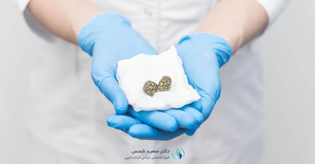 سنگ کیسه صفرا آیا واقعا خطرناکه؟