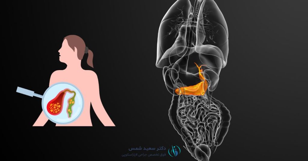 بهترین نوشیدنی‌ها برای سنگ کیسه صفرا