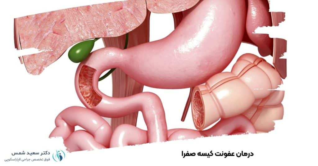 درمان عفونت کیسه صفرا 