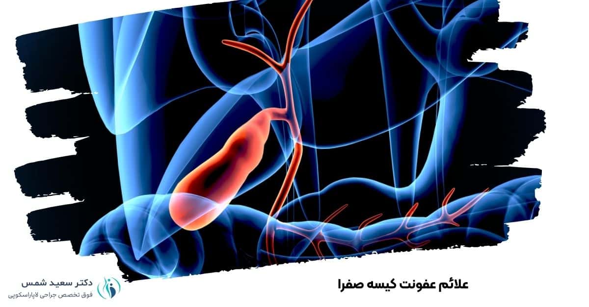 علائم عفونت کیسه صفرا 