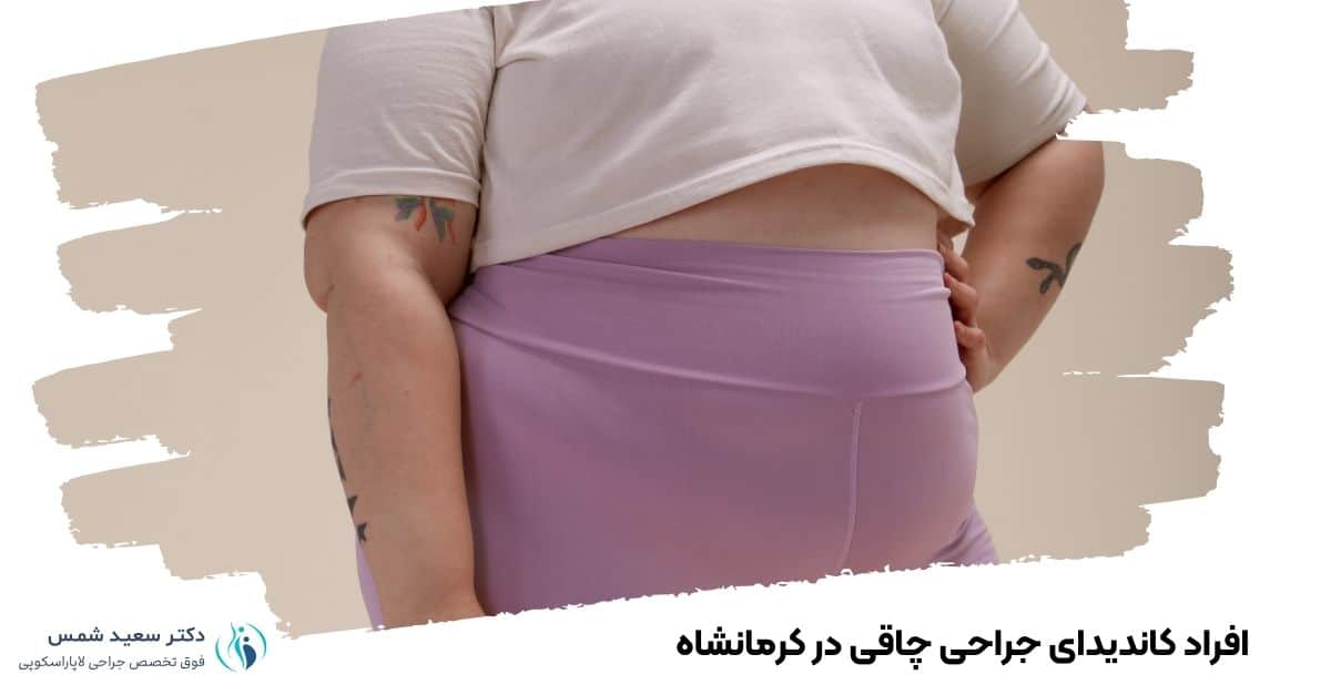 افراد کاندیدای جراحی چاقی در کرمانشاه 