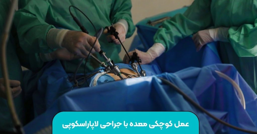 عمل کوچکی معده با جراحی لاپاراسکوپی