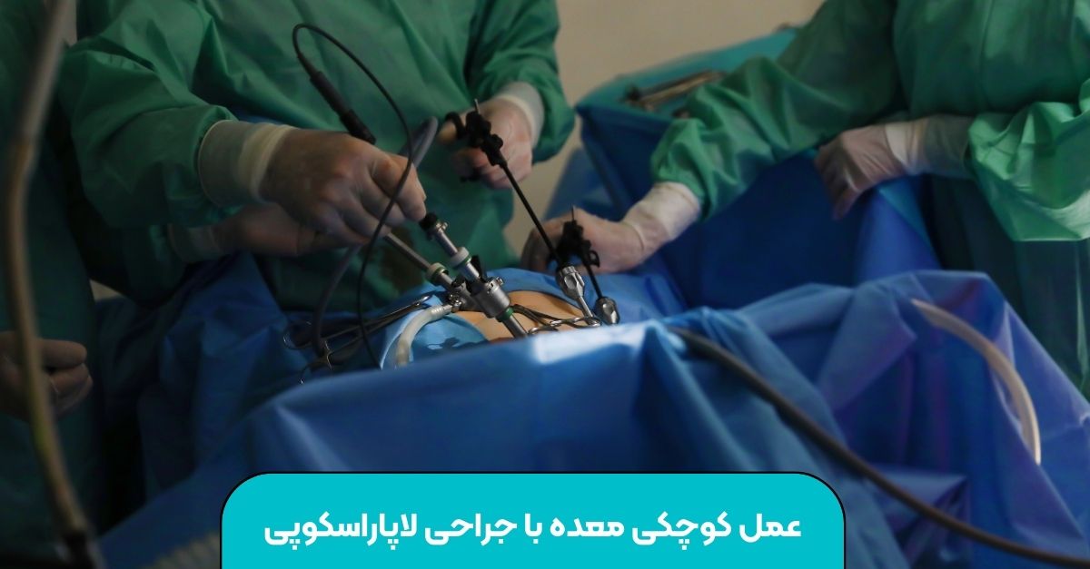 عمل کوچکی معده با جراحی لاپاراسکوپی