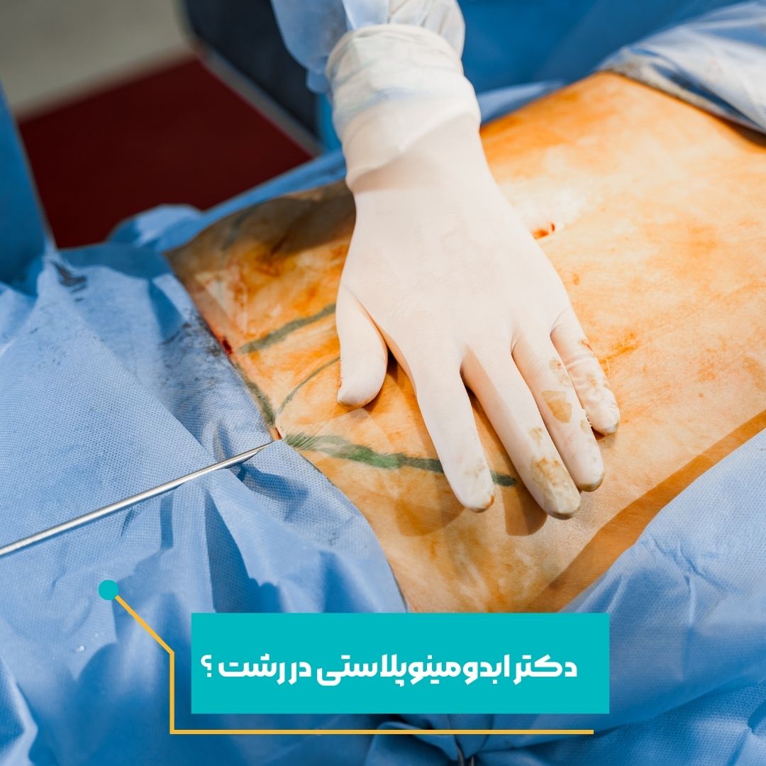 دکترابدومینوپلاستی در رشت