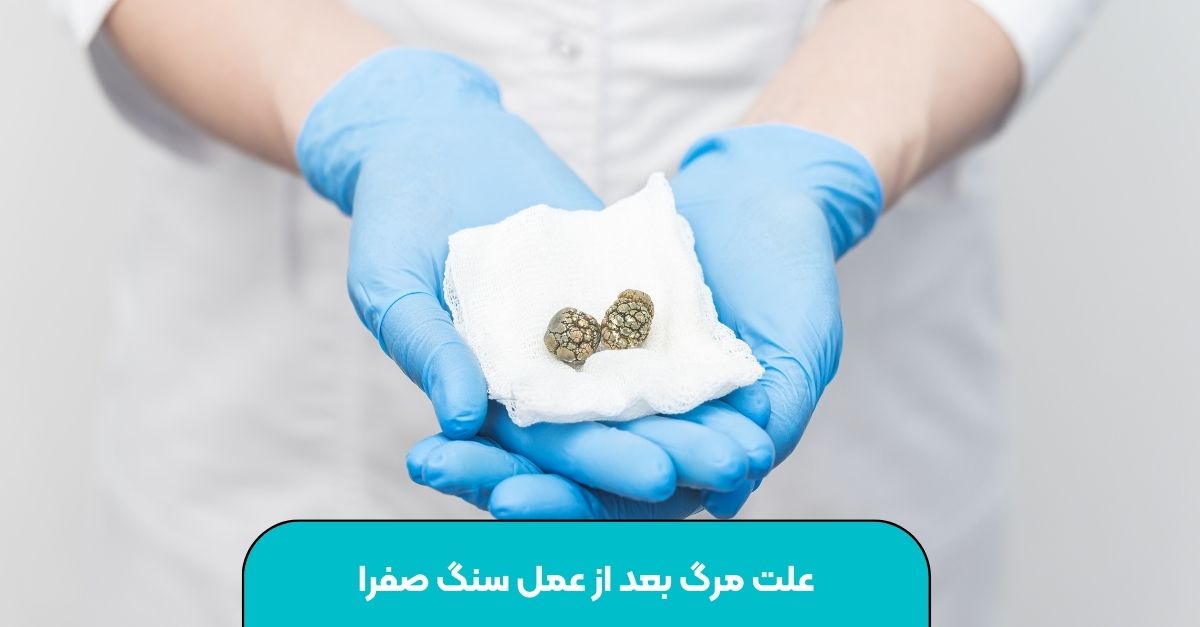 علت مرگ بعد از عمل سنگ صفرا