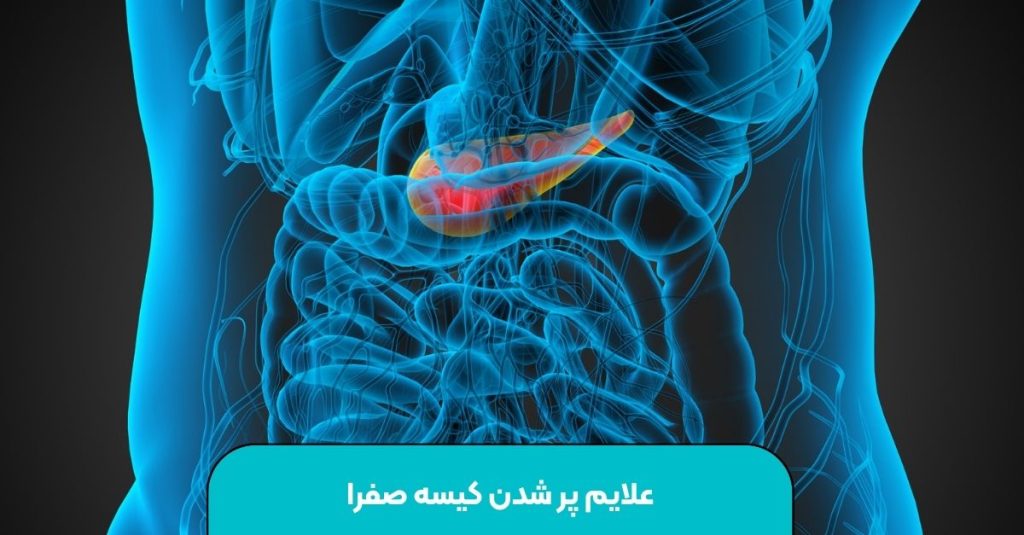علایم پر شدن کیسه صفرا